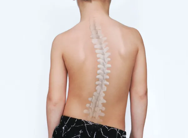 側弯症の原因は?